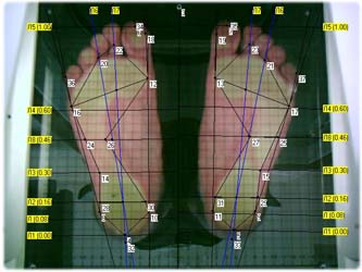 Плантоскоп Подбор ортопедических изделий с помощью плантоскопа